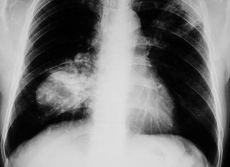 Google researchers trained an algorithm to detect lung cancer Google Researchers trained an algorithm to detect Lung Cancer better than radiologists