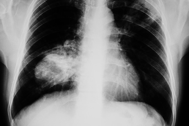 Google Researchers trained an algorithm to detect Lung Cancer better than radiologists