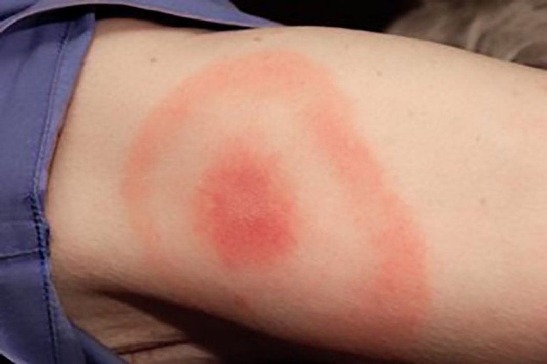 Lyme disease is three times higher than estimated in the UK