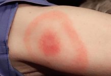 Lyme disease is three times higher than estimated in the UK Lyme disease is three times higher than estimated in the UK