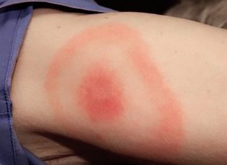 Lyme disease is three times higher than estimated in the UK Lyme disease is three times higher than estimated in the UK
